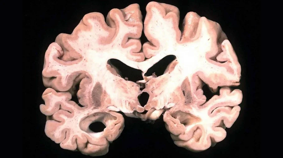 Ученые нашли новую часть головоломки в понимании того, как работает мозг пациентов с болезнью Альцгеймера